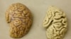 治療腦癌出現新技術